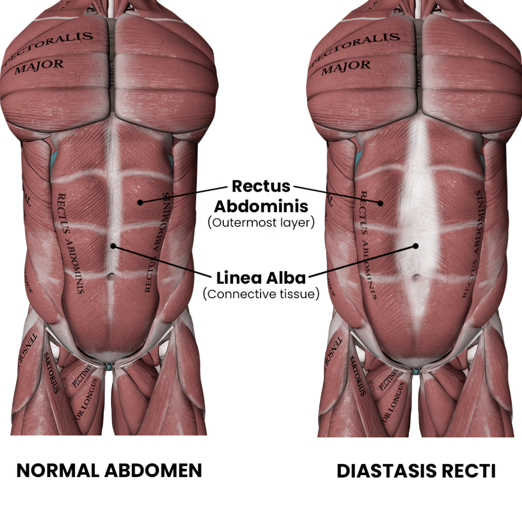 Fixing Diastasis Recti_Compare